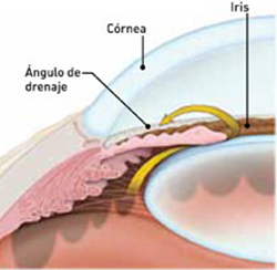 Causas de la Glaucoma